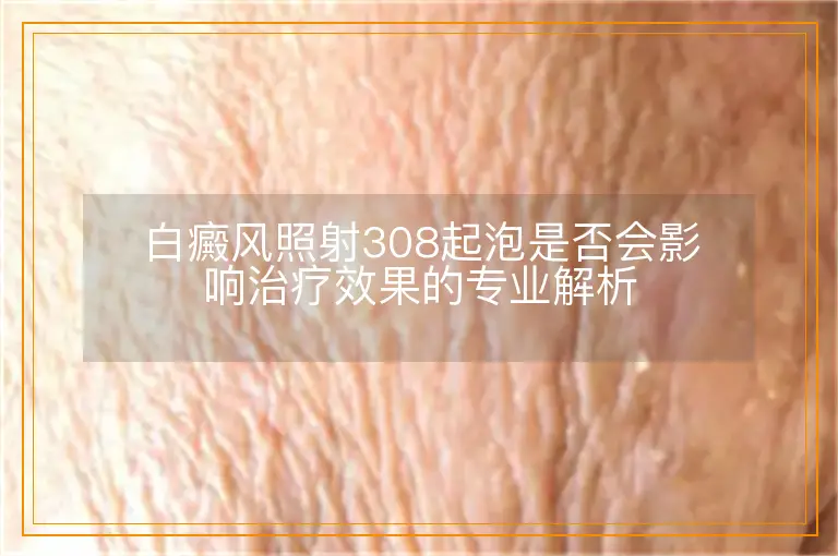 白癜风照射308起泡是否会影响治疗效果的专业解析
