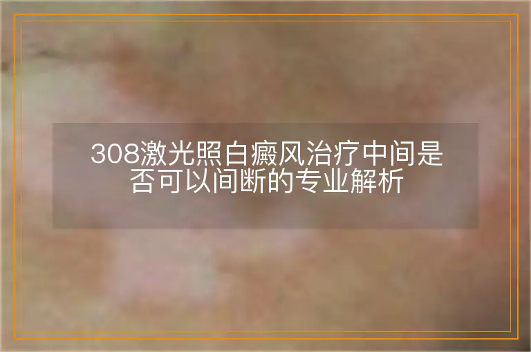 308激光照白癜风治疗中间是否可以间断的专业解析