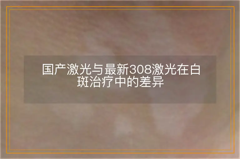 国产激光与最新308激光在白斑治疗中的差异