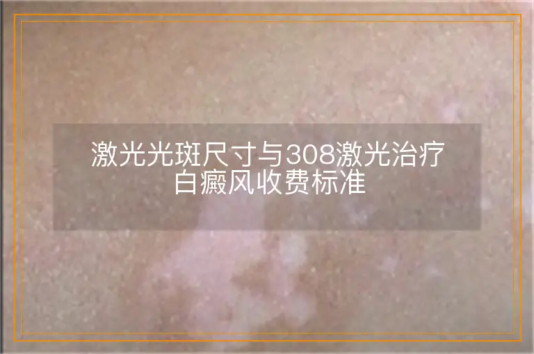 激光光斑尺寸与308激光治疗白癜风收费标准