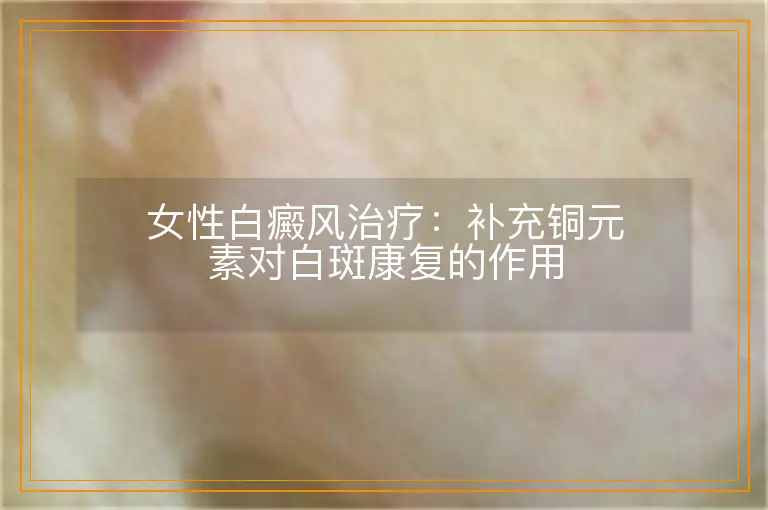 女性白癜风治疗：补充铜元素对白斑康复的作用