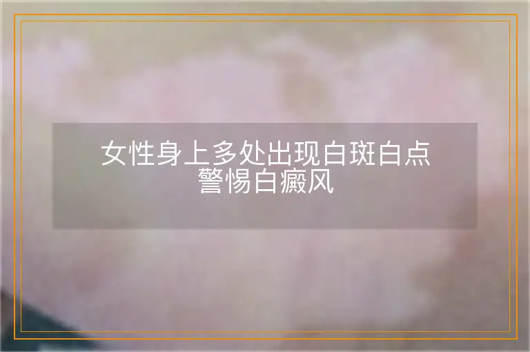 女性身上多处出现白斑白点警惕白癜风