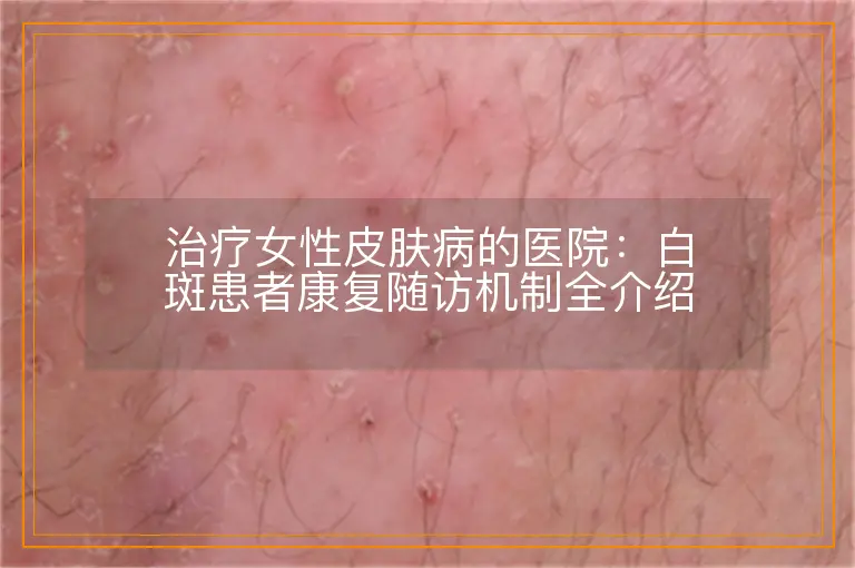 治疗女性皮肤病的医院:白斑患者康复随访机制全介绍