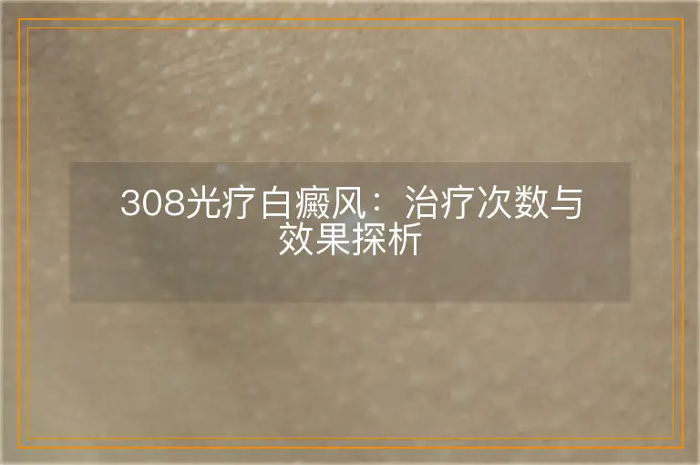 308光疗白癜风：治疗次数与效果探析