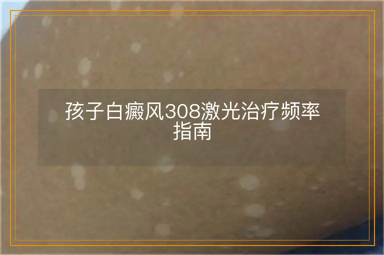 孩子白癜风308激光治疗频率指南