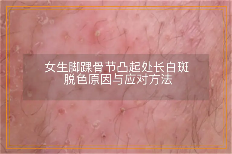 女生脚踝骨节凸起处长白斑 脱色原因与应对方法