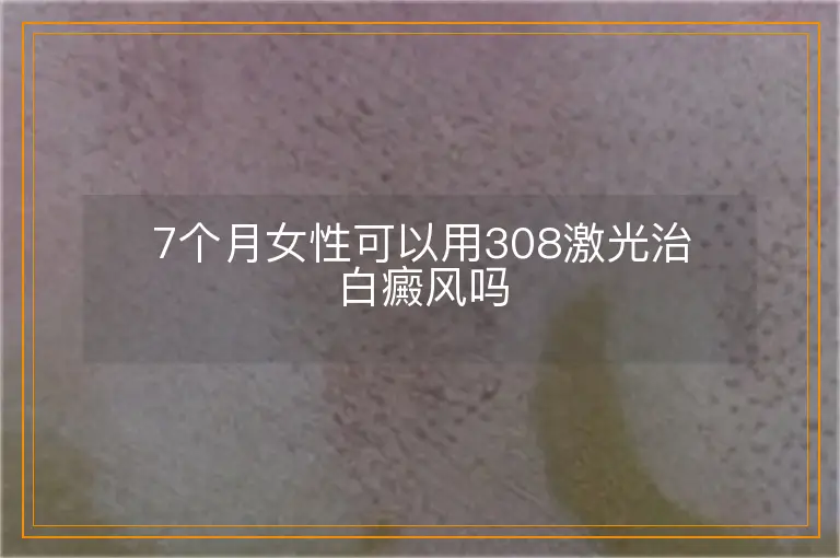 7个月女性可以用308激光治白癜风吗