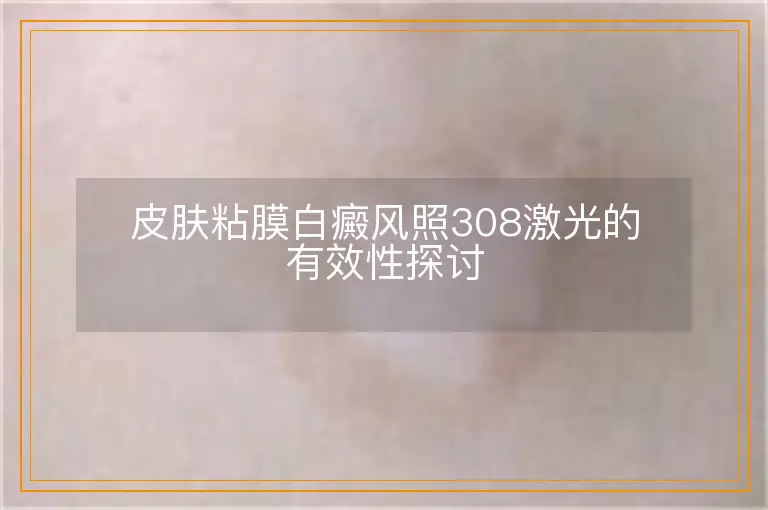 皮肤粘膜白癜风照308激光的有效性探讨