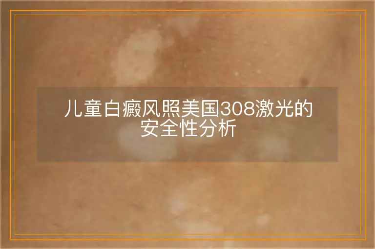 儿童白癜风照美国308激光的安全性分析