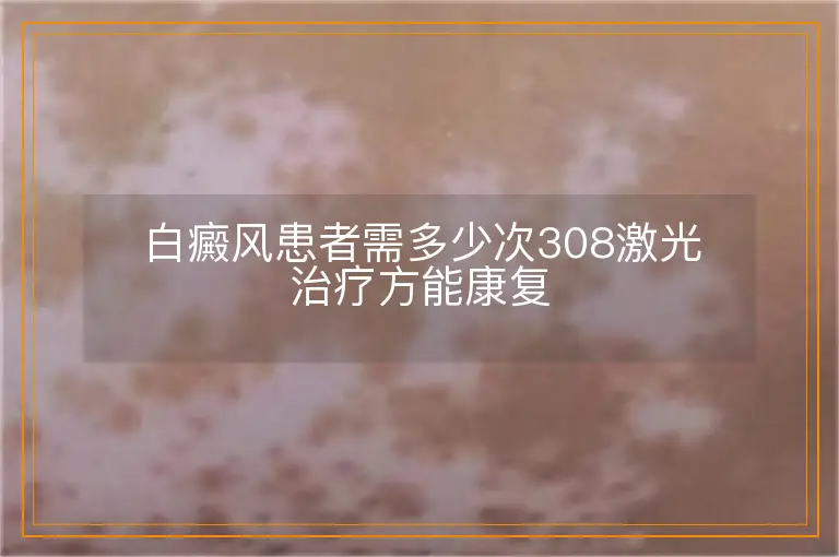 白癜风患者需多少次308激光治疗方能康复