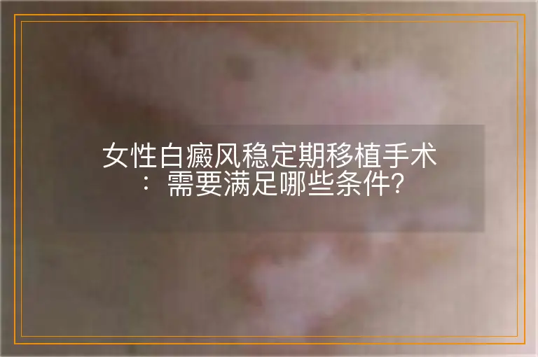 女性白癜风稳定期移植手术：需要满足哪些条件？
