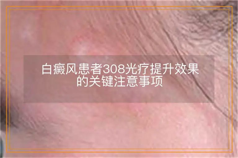 白癜风患者308光疗提升效果的关键注意事项