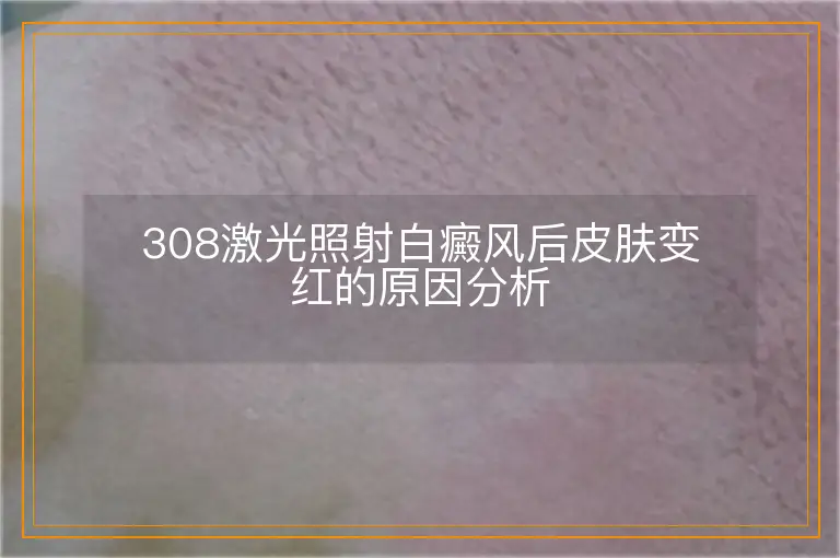 308激光照射白癜风后皮肤变红的原因分析