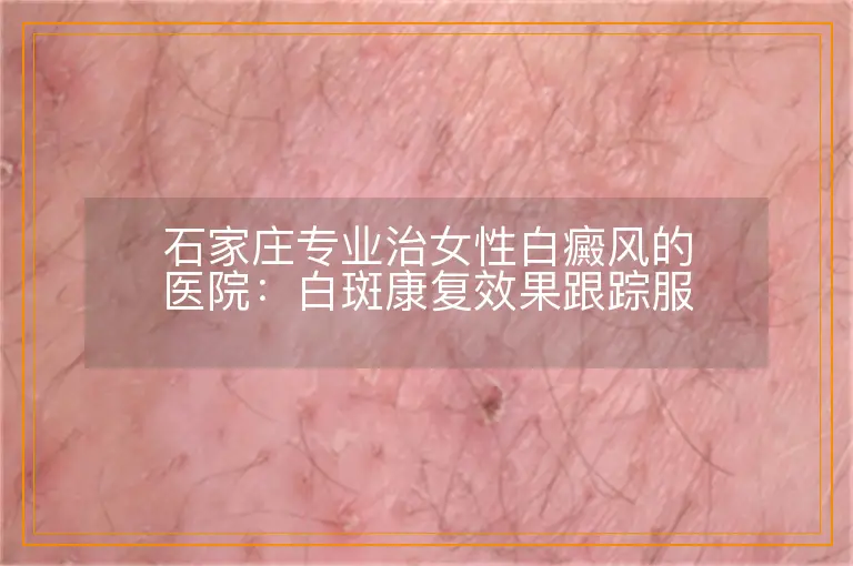 石家庄专业治女性白癜风的医院:白斑康复效果跟踪服务