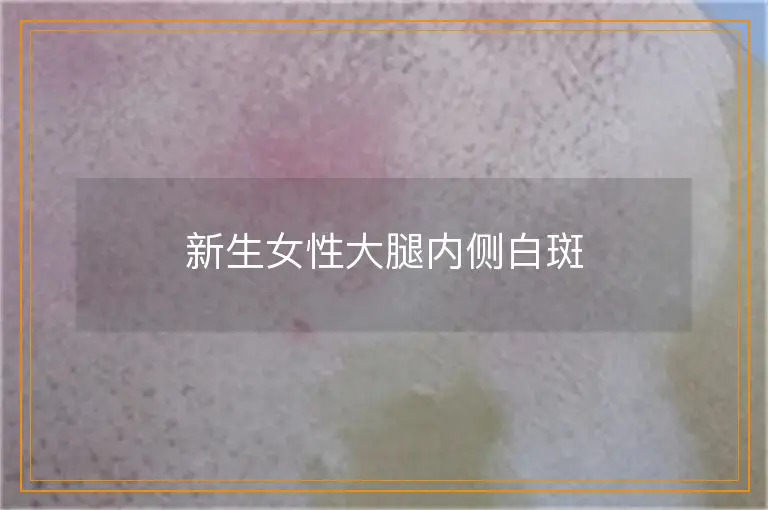 新生女性大腿内侧白斑