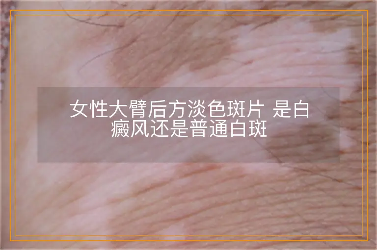 女性大臂后方淡色斑片 是白癜风还是普通白斑