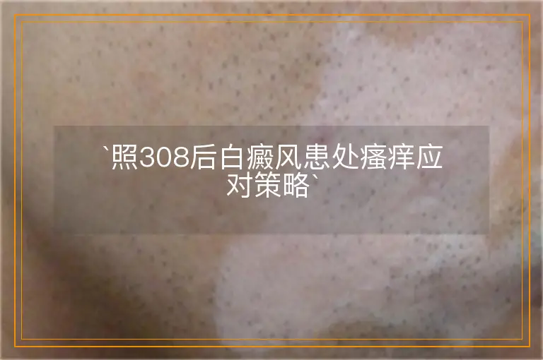 照308后白癜风患处瘙痒应对策略