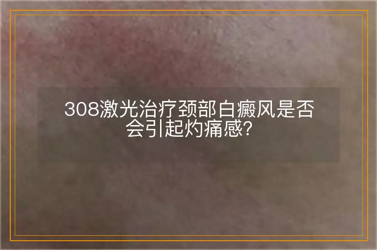 308激光治疗颈部白癜风是否会引起灼痛感？