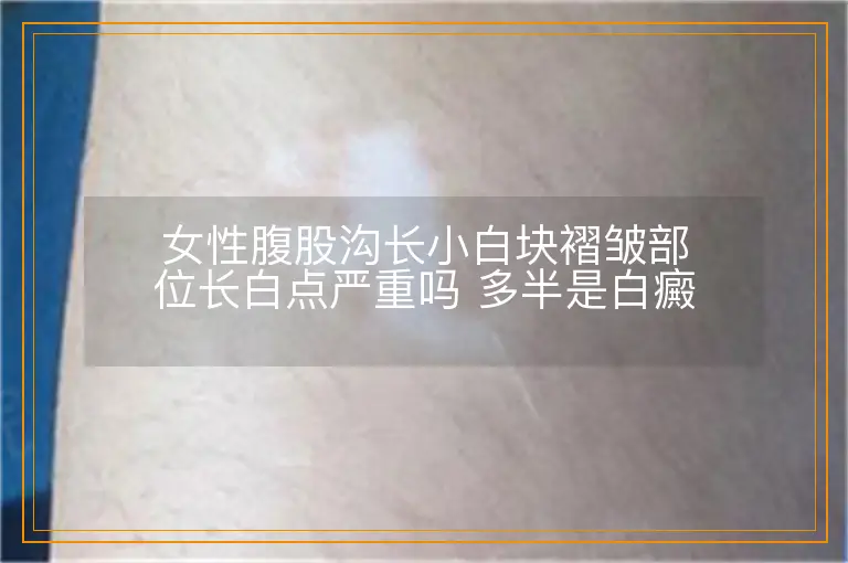 女性腹股沟长小白块褶皱部位长白点严重吗 多半是白癜风先别慌