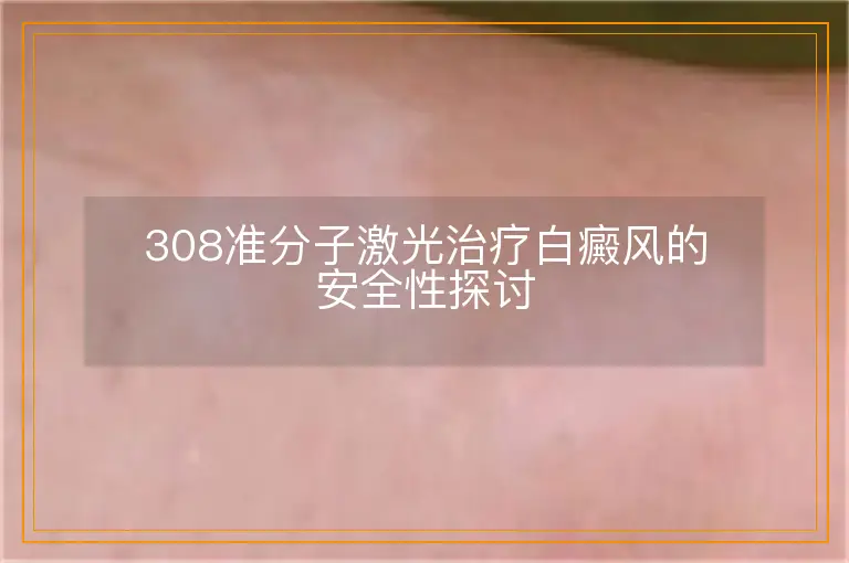 308准分子激光治疗白癜风的安全性探讨