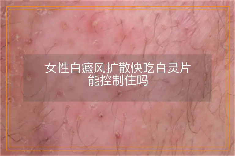 女性白癜风扩散快吃白灵片能控制住吗