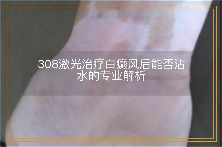 308激光治疗白癜风后能否沾水的专业解析