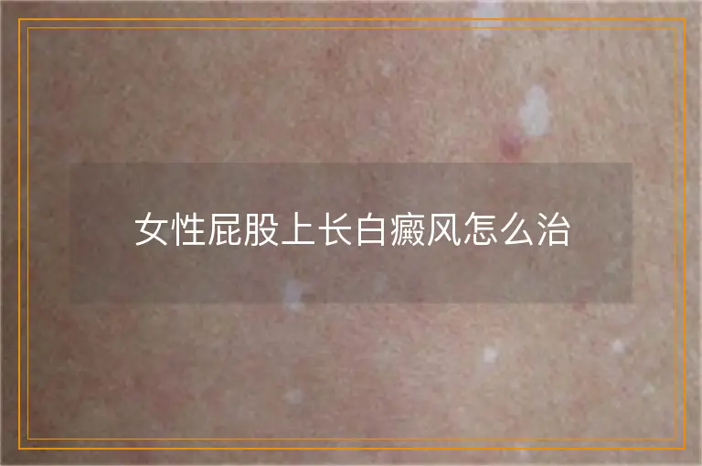 女性屁股上长白癜风怎么治