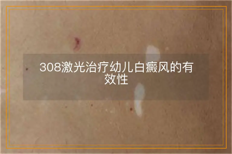 308激光治疗幼儿白癜风的有效性