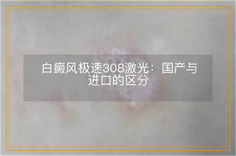 白癜风极速308激光：国产与进口的区分