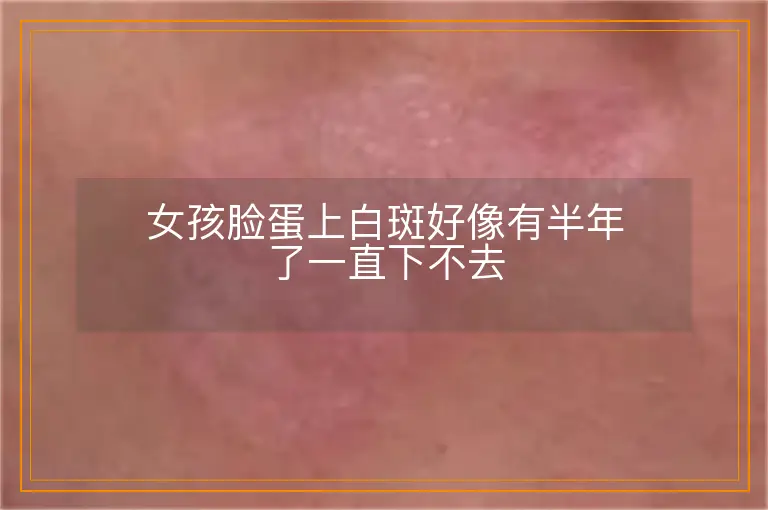 女孩脸蛋上白斑好像有半年了一直下不去
