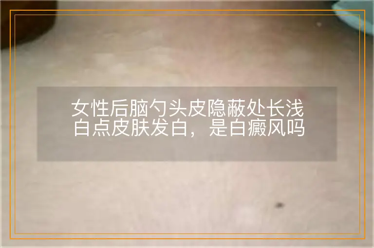 女性后脑勺头皮隐蔽处长浅白点皮肤发白,是白癜风吗