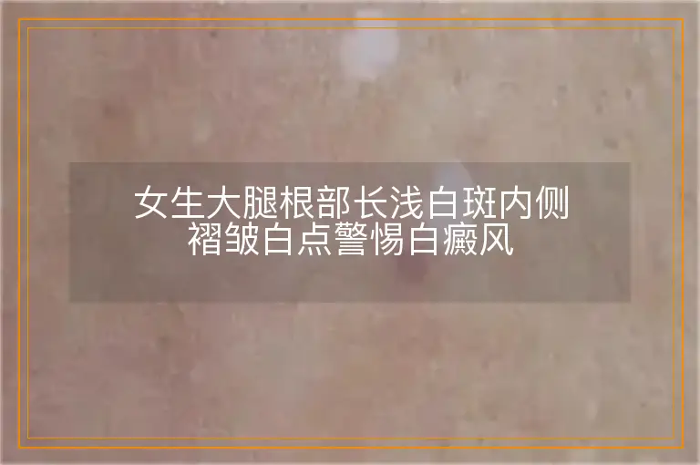 女生大腿根部长浅白斑内侧褶皱白点警惕白癜风