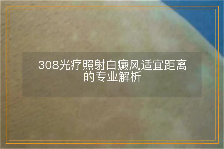 308光疗照射白癜风适宜距离的专业解析