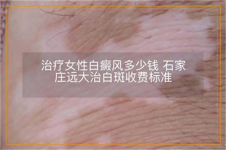 治疗女性白癜风多少钱 石家庄远大治白斑收费标准