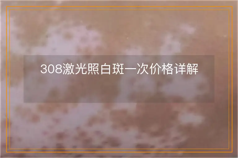 308激光照白斑一次价格详解