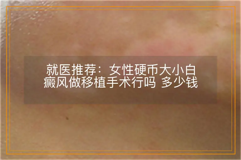 就医推荐:女性硬币大小白癜风做移植手术行吗 多少钱