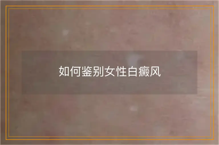 如何鉴别女性白癜风