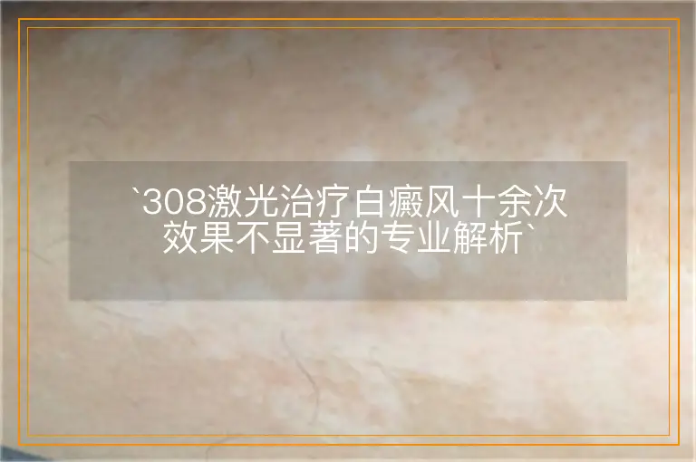 308激光治疗白癜风十余次效果不显著的专业解析