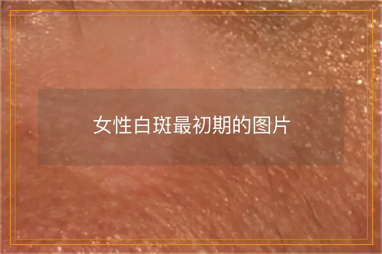 女性白斑最初期的图片