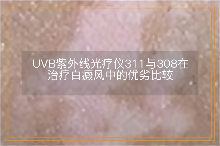 UVB紫外线光疗仪311与308在治疗白癜风中的优劣比较