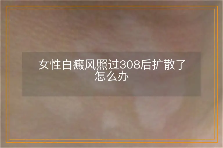 女性白癜风照过308后扩散了怎么办