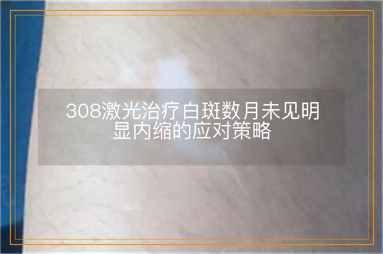 308激光治疗白斑数月未见明显内缩的应对策略