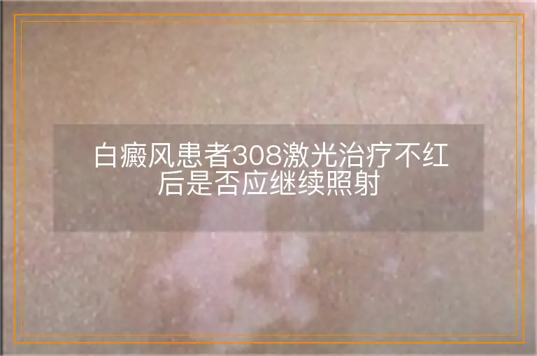 白癜风患者308激光治疗不红后是否应继续照射
