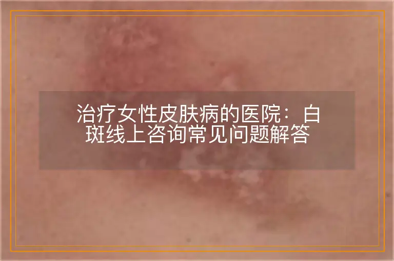 治疗女性皮肤病的医院:白斑线上咨询常见问题解答