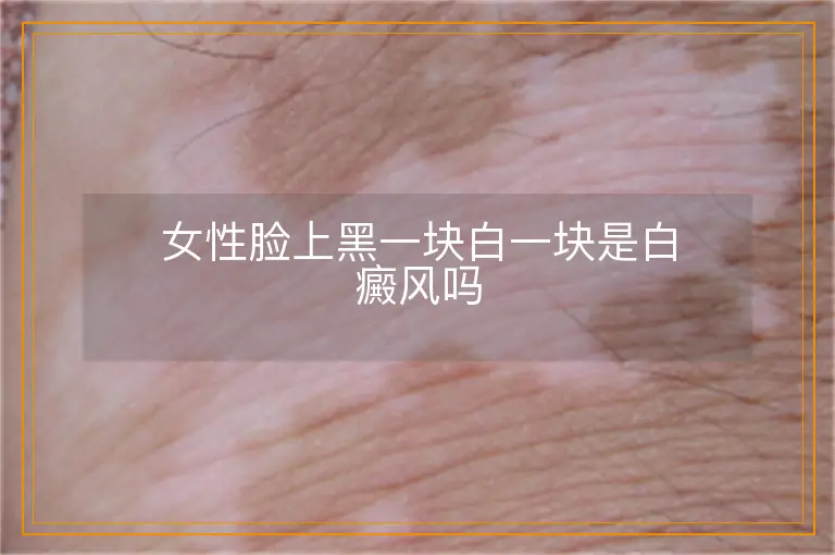 女性脸上黑一块白一块是白癜风吗