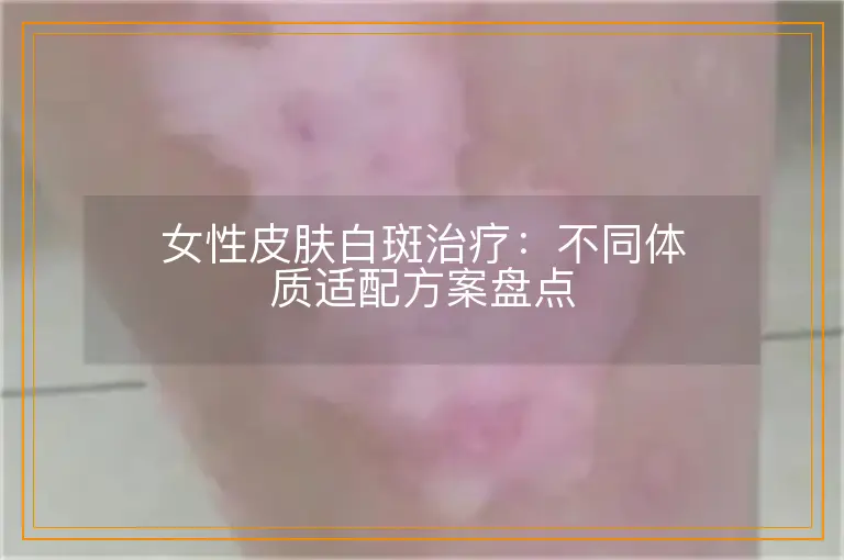 女性皮肤白斑治疗:不同体质适配方案盘点