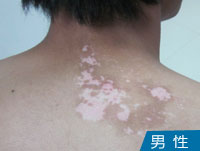 男性背部白癜风图片